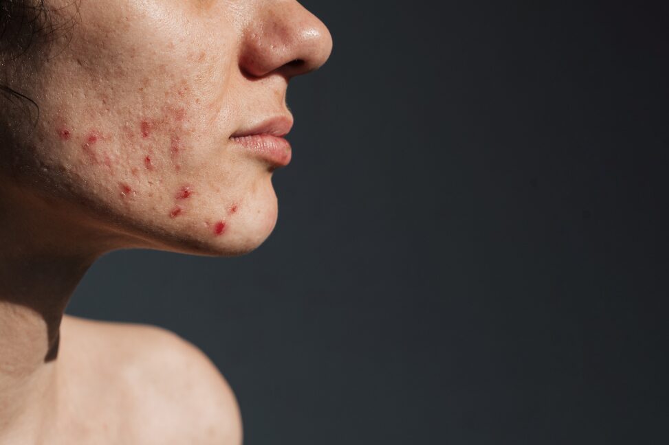 Holistic Skincare for Hormonal Acne: Your Guide to Clear Skin