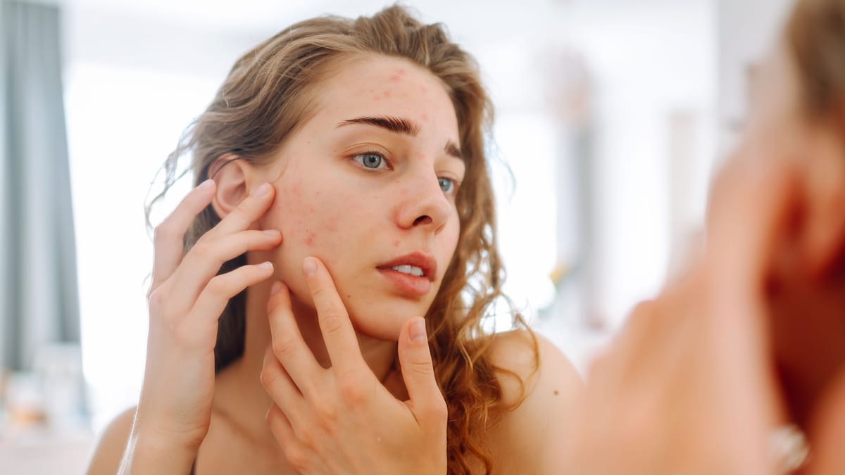 Period Pimples: Understanding Hormonal Acne & How to Fight It